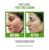 Anti-Acne Tea Tree Serum