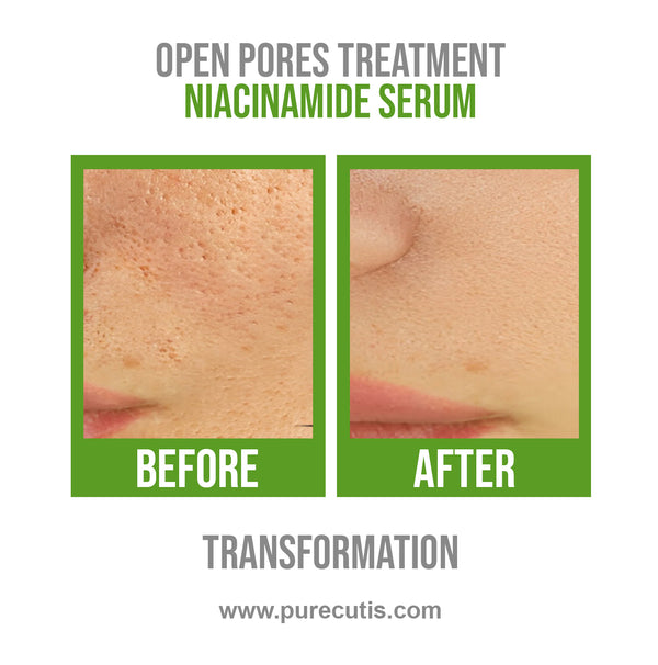 Niacinamide 10% + Zinc 1% Serum