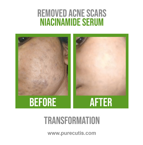 Niacinamide 10% + Zinc 1% Serum